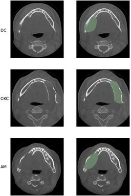 Odontogenic cystic lesion segmentation on cone-beam CT using an auto-adapting multi-scaled UNet